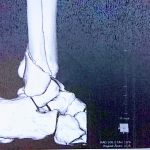 右足腓骨骨折～手術～リハビリの記録②
