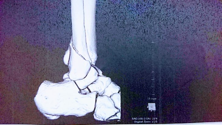 右足腓骨骨折～手術～リハビリの記録②
